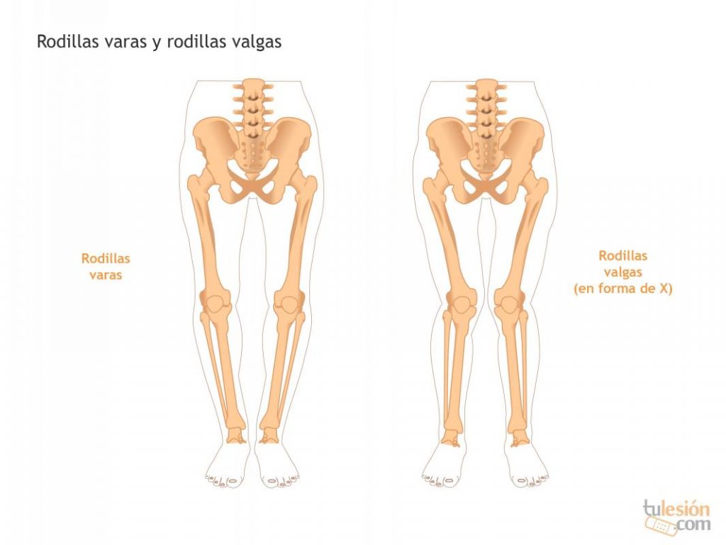 RODILLA VARA - Cirugia de Columna en Matamoros
