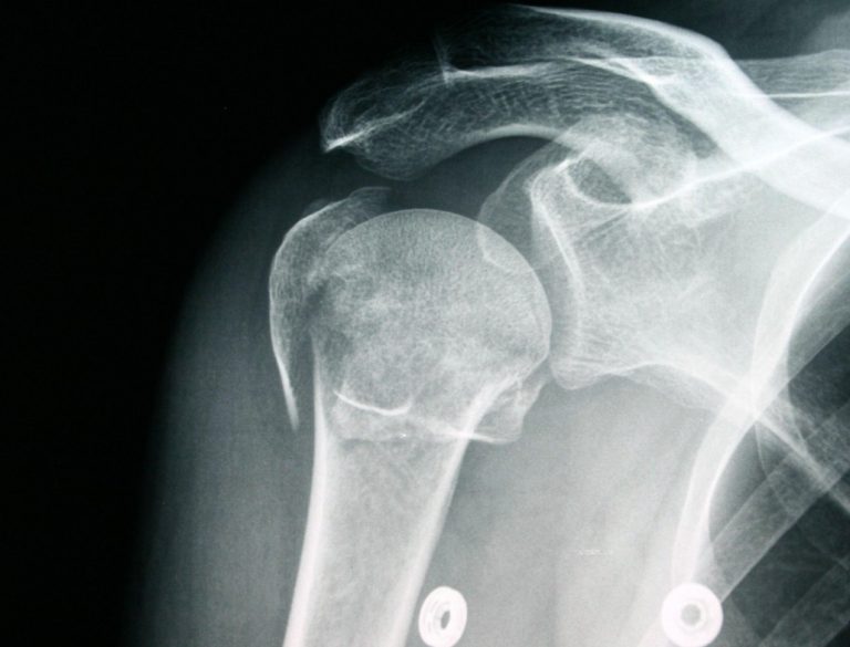 FRACTURA DE HUMERO - Cirugia de Columna en Matamoros