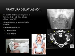 FRACTURA DE JEFFERSON - Cirugia de Columna en Matamoros